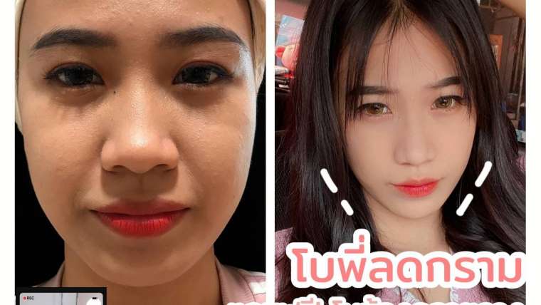 รีวิวโบท็อกซ์