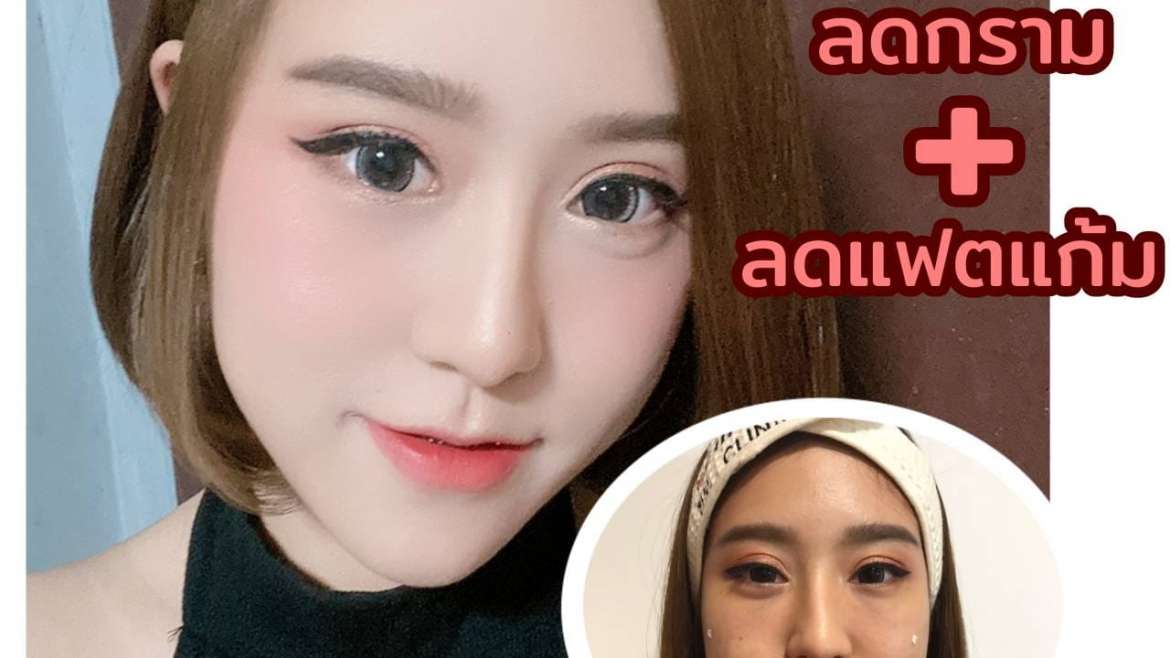 รีวิวโบท็อกซ์ 2