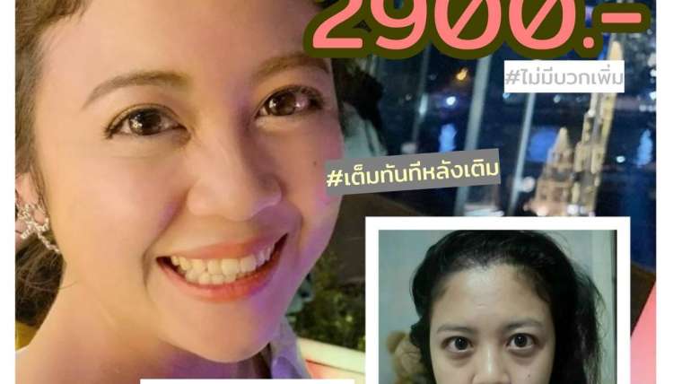 รีวิว PRP เติมใต้ตา 2