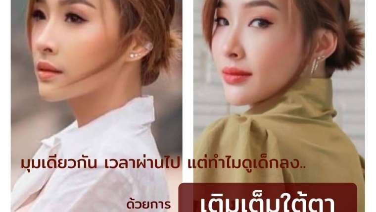 รีวิว PRP เติมใต้ตา