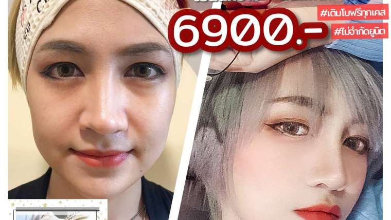 ่รีวิวโบท็อกซ์ 3