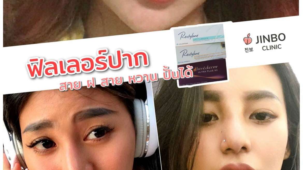 รีวิวฟิลเลอร์ปาก 5