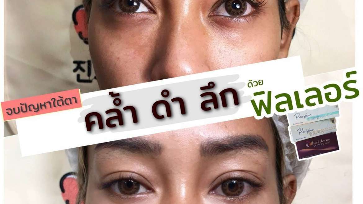 รีวิวฟิลเตอร์ใต้ตา 6