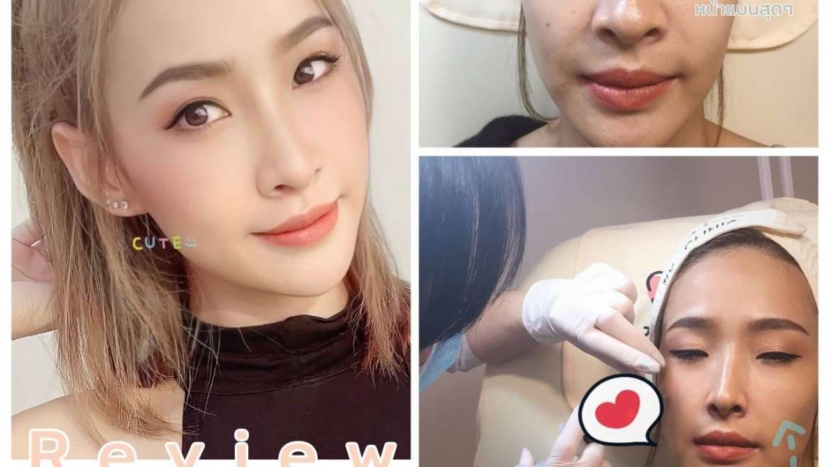 รีวิวฟิลเลอร์ 3