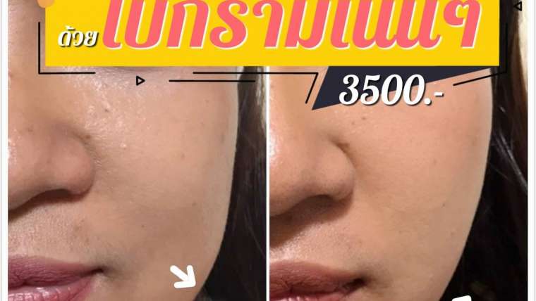 รีวิวโบท็อกซ์ 8