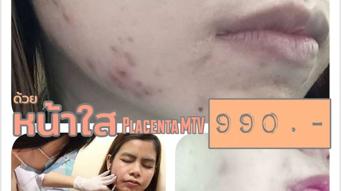 รีวิวฉีดหน้าใส 2