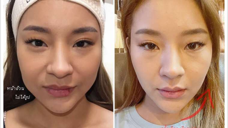 รีวิวโบท็อกซ์ 5