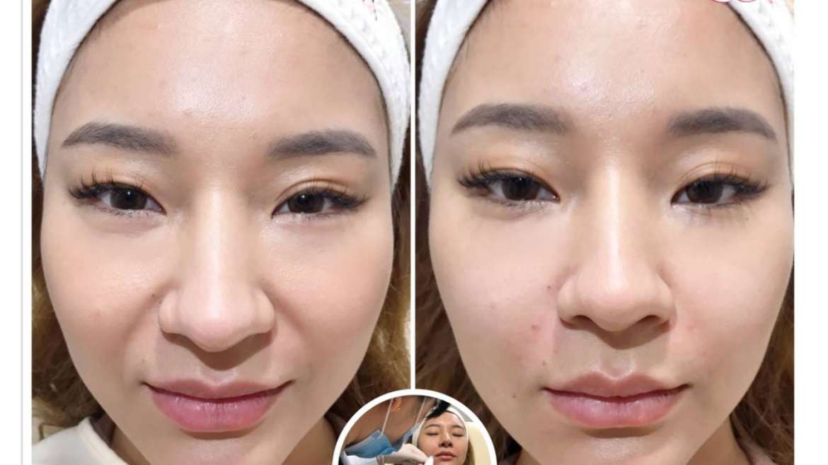 รีวิวฟิลเลอร์