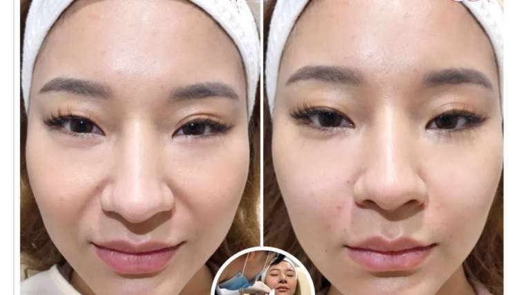 รีวิวฟิลเลอร์