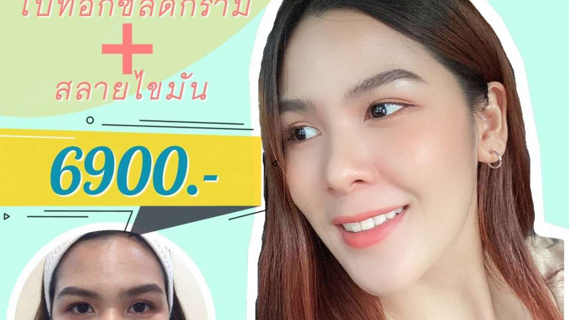 รีวิวโบท็อกซ์ 6
