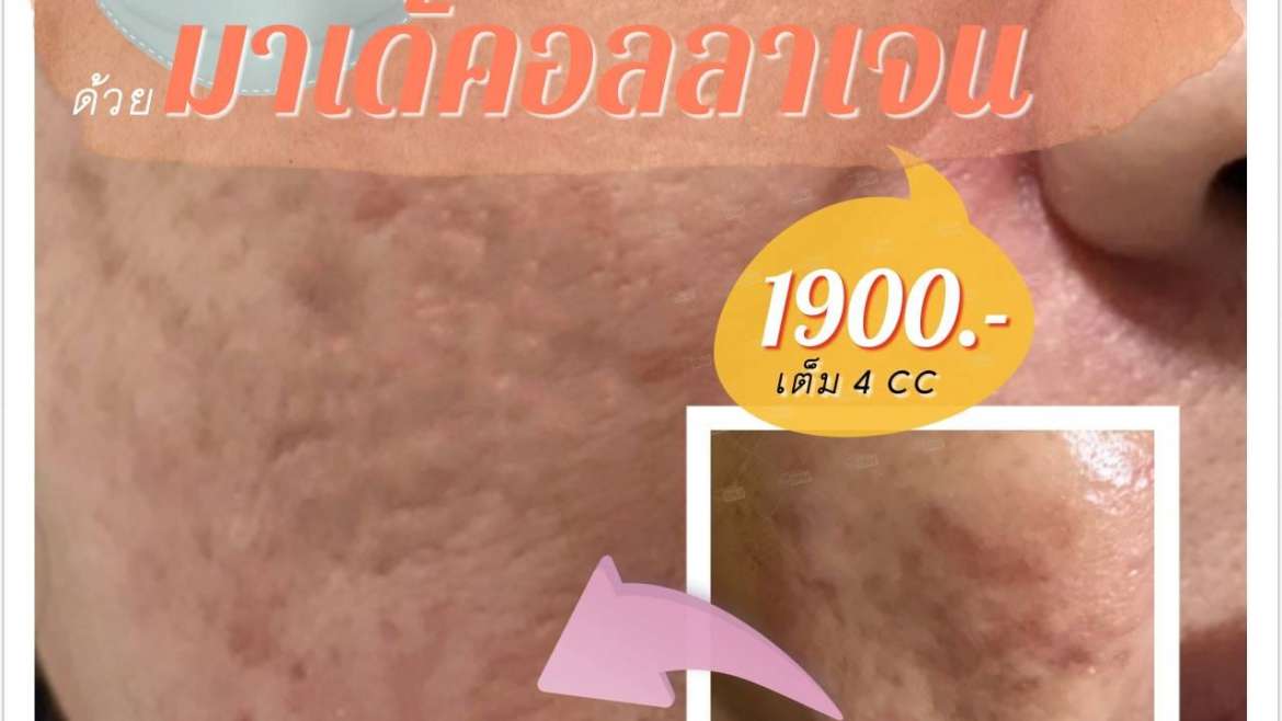 รีวิวฉีดหน้าใส