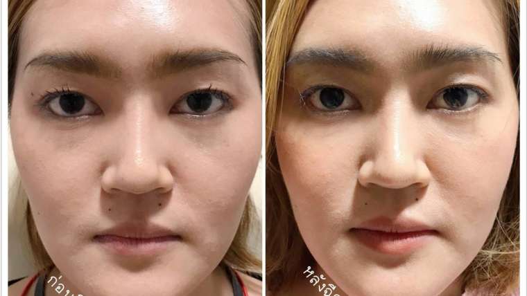 รีวิวฟิลเลอร์ 2