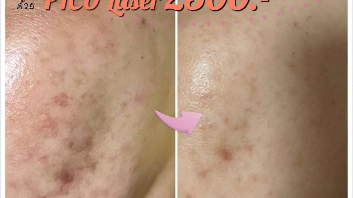 รีวิวเลเซอร์
