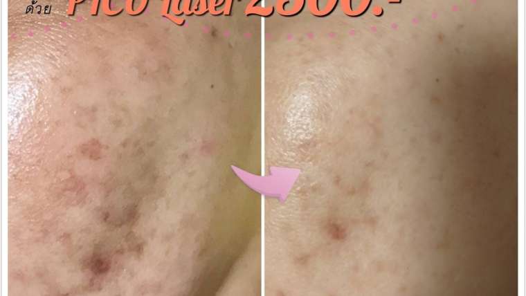 รีวิวเลเซอร์