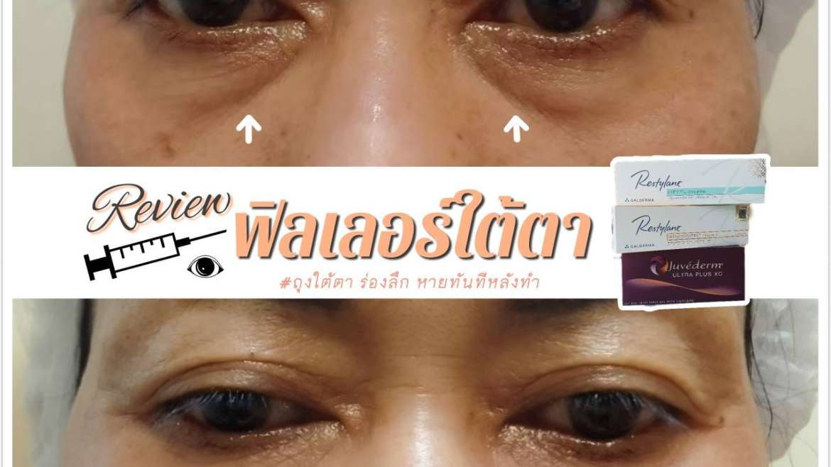 รีวิวฟิลเตอร์ใต้ตา 4