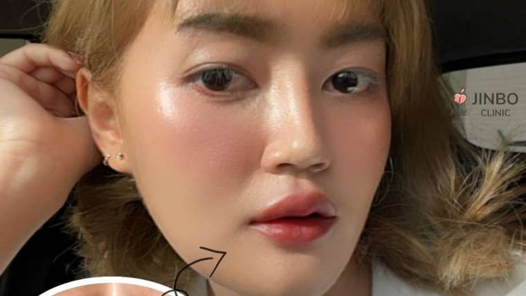 รีวิวฟิลเลอร์ปาก 2