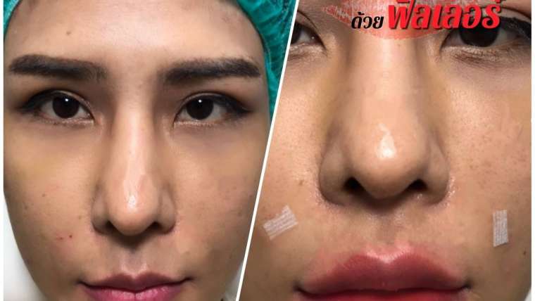 รีวิวฟิลเลอร์ปาก