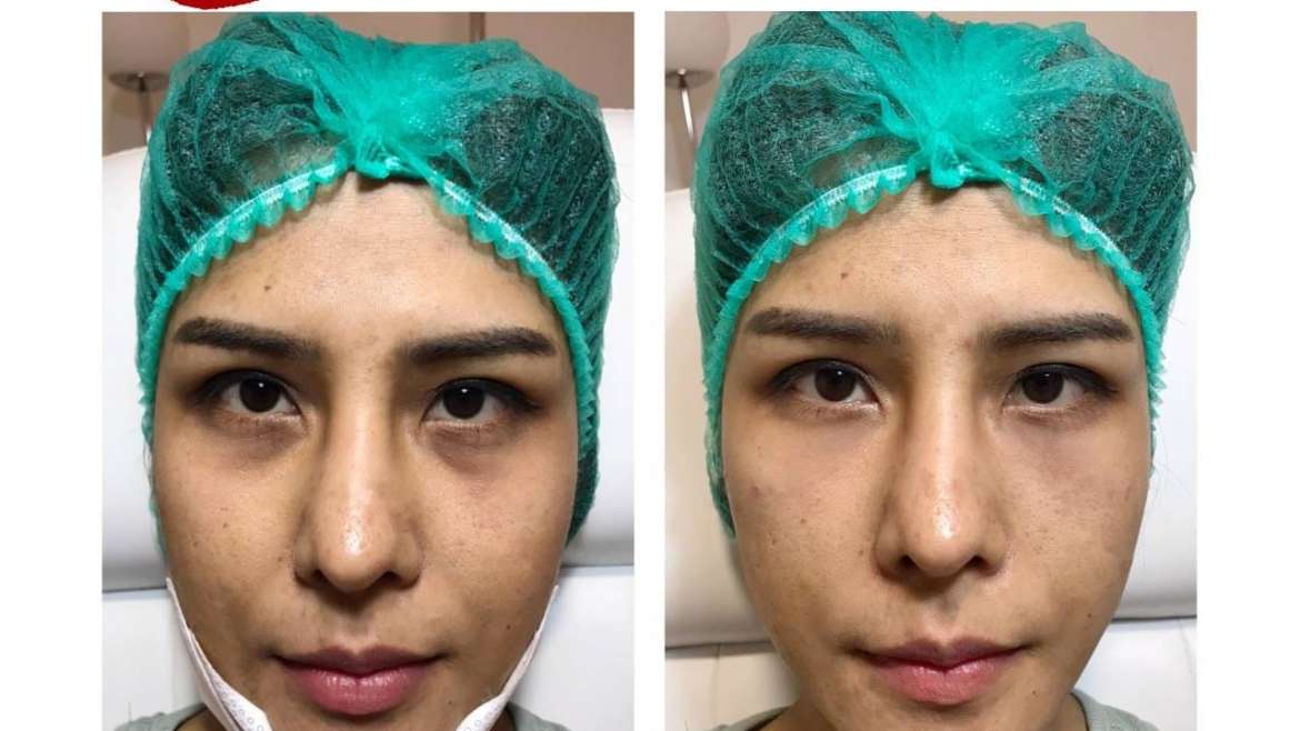 รีวิวฟิลเตอร์ใต้ตา 3