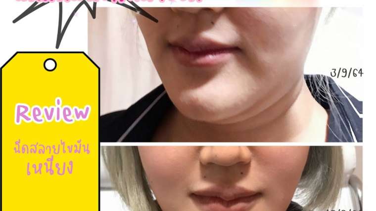รีวิวโบท็อกซ์ 11
