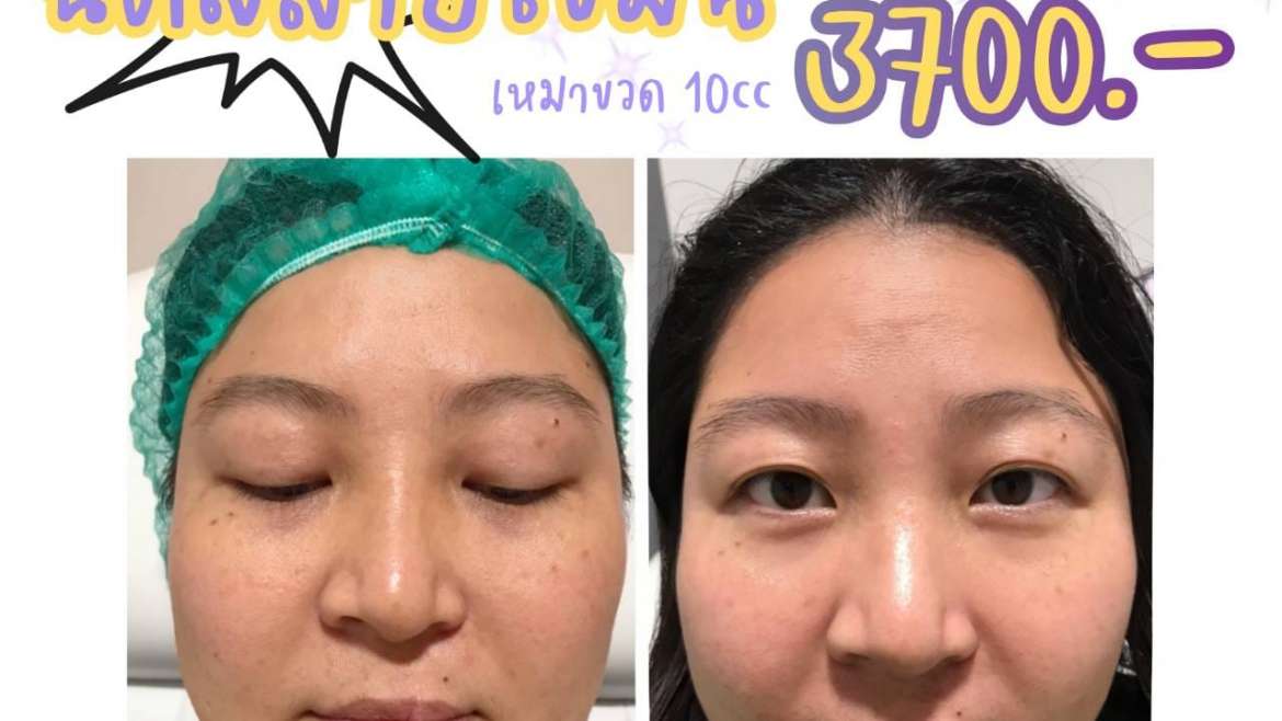 รีวิวโบท็อกซ์ 10
