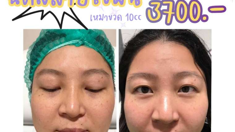 รีวิวโบท็อกซ์ 10